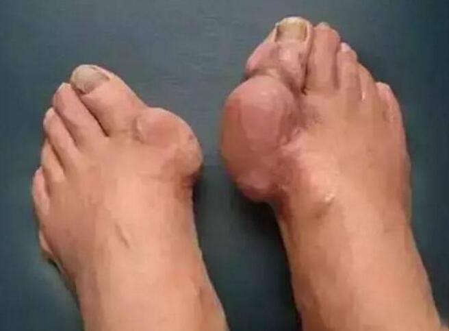 遵义痛风医院专家告诉你什么食物痛风患者不能吃 遵义痛风医院专家告诉你什么食物痛风患者不能吃