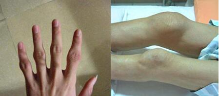 环卫师傅患风湿性关节炎3年我院科学治疗助他恢复健康 环卫师傅患风湿性关节炎3年我院科学治疗助他恢复健康