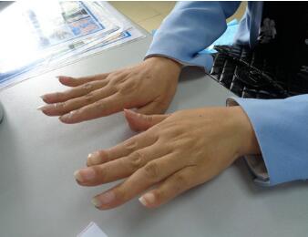 手指肿胀消失 手指肿胀消失