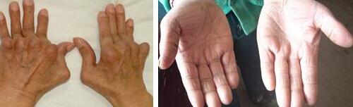 张大妈类风湿治疗前后对比 张大妈类风湿治疗前后对比