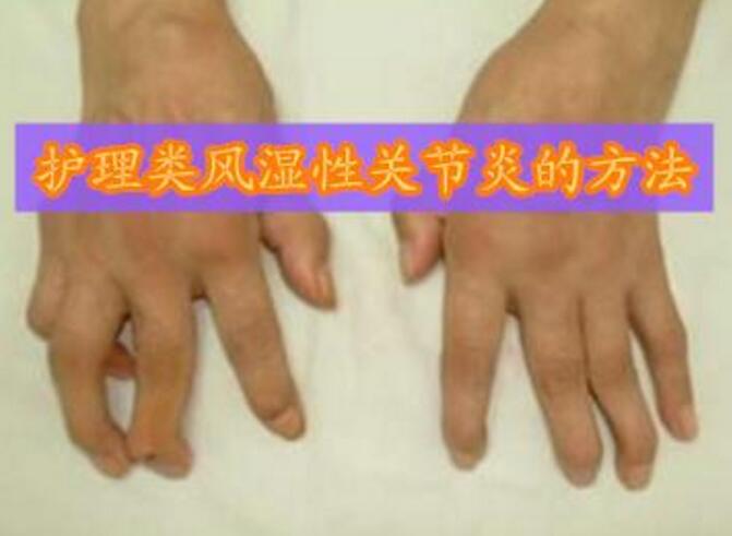 遵义风湿病医院护理人员要知道类风湿性关节炎的护理方法