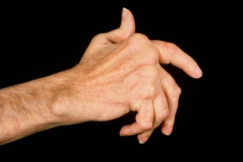 预防风湿病应注意劳逸结合切忌过度劳累 预防风湿病应注意劳逸结合切忌过度劳累