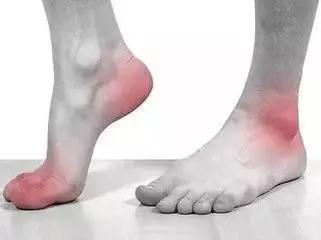 得了风湿，该不该看中医？