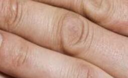 遵义风湿病医院答疑风湿病会引起晚上睡觉浑身肌肉疼吗 遵义风湿病医院答疑风湿病会引起晚上睡觉浑身肌肉疼吗