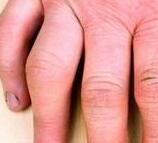 遵义痛风专科医院:关节病变性痛风的饮食 遵义痛风专科医院:关节病变性痛风的饮食